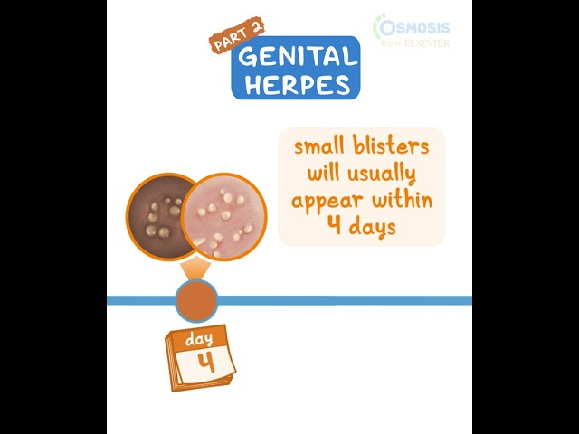 Genital Herpes pt 2