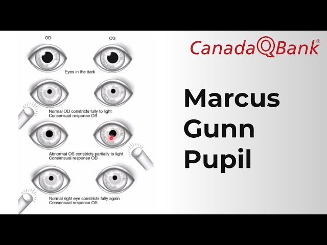 Marcus Gunn Pupil Explained | Relative Afferent Pupillary Defect (RAPD) | CanadaQBank