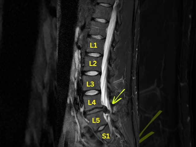 How to fix Lumbar Disc Extrusion #extrusion #sciatica #reabsorption