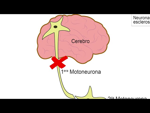 What Is Amyotrophic Lateral Sclerosis (ALS)?