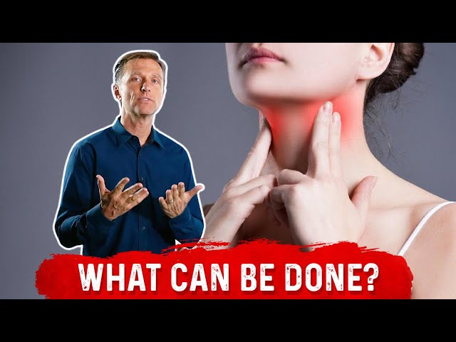 90% of Hypothyroidism Is Hashimoto’s Thyroiditis | Dr. Berg