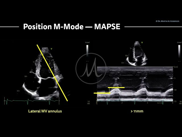 〖Echocardiography〗 MAPSE - left ventricular function with M-Mode