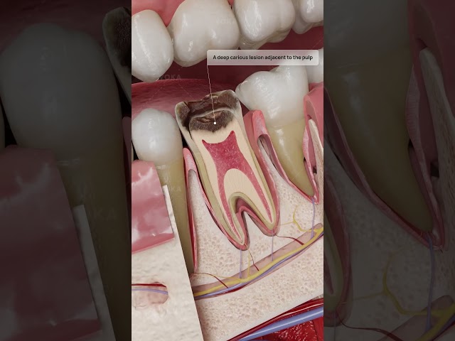 ¿Qué es la pulpitis reversible y cómo se puede tratar? En 3D