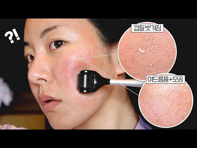 심한 모공+여드름흉 피부...MTS 한달동안 해봄🔥 내돈내산 솔직 리뷰!! (부작용, 효과, 주기)
