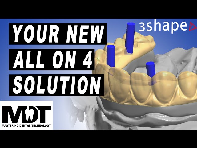 3Shape Crystal Ultra Design Tutorial [The All on 4 Implant Hybrid  Bar Solution]