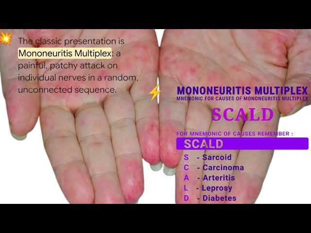 🩹 Mononeuritis Multiplex  🩹