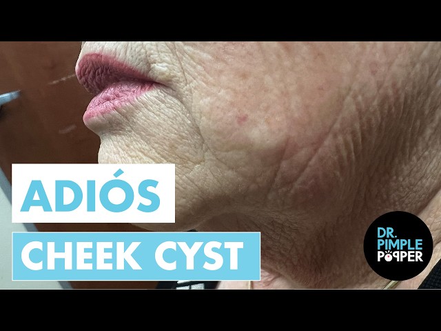 Adiós Cheek Cyst! | Dr. Pimple Popper Removes an Epidermoid Cyst
