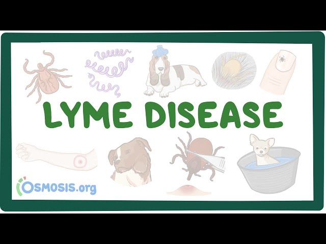 Lyme disease - causes, symptoms, diagnosis, treatment, pathology