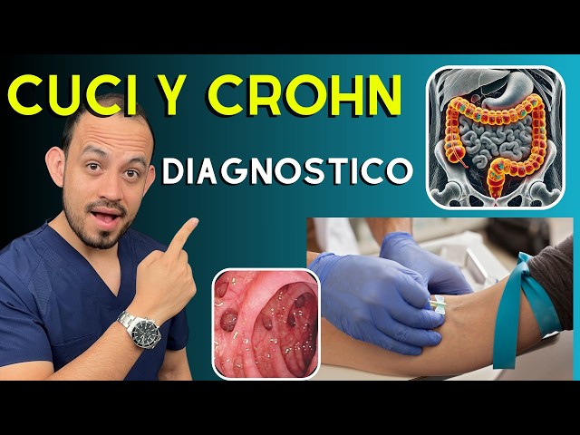 Colonoscopy and Laboratory Tests in Crohn's Disease and Ulcerative Colitis (UC) - Diagnosis