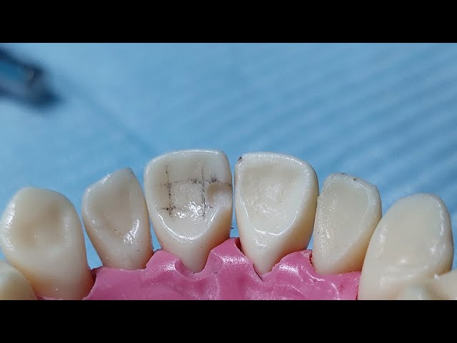 cavity preparation class III for Composite restoration/#Dr_ghazal