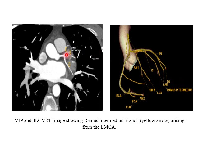 HARGUNEET KAUR | CT Coronary Angiography in Coronary Anomalies and Normal Variants