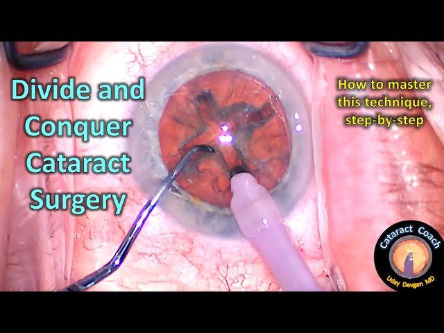 learn to master Divide-and-Conquer Cataract Surgery (Phaco Technique)