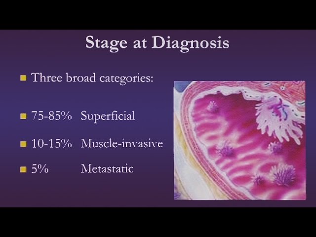 Bladder Cancer