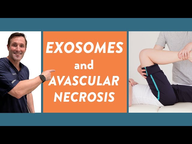 Exosomes and avascular necrosis