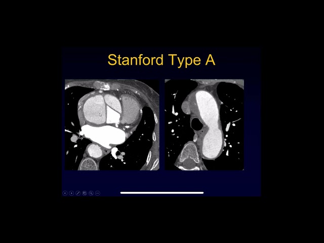 CT evaluation of Aortic dissection and intramural hematoma