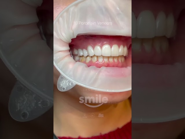 Same Day Porcelain Veneers finished within 2 HOURS by Dr Robbie using the First Fit technique🔥