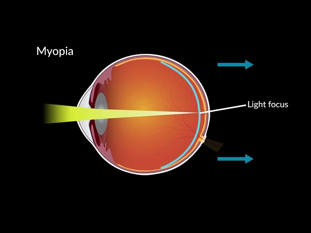Myopia and Eye Development
