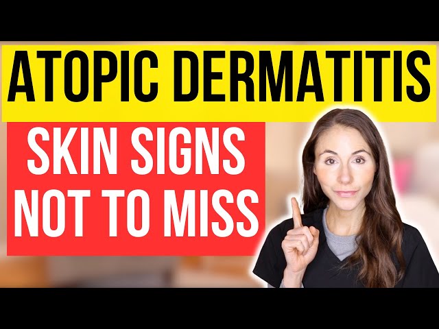 Don't Miss These 15 Signs Of Atopic Dermatitis!
