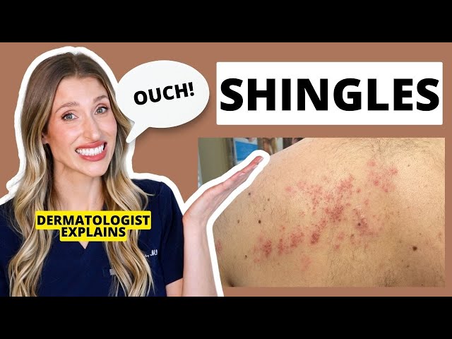 Dermatologist Explains Shingles: Is it Contagious? Shingles Treatments & Prevention? | Dr. Sam Ellis