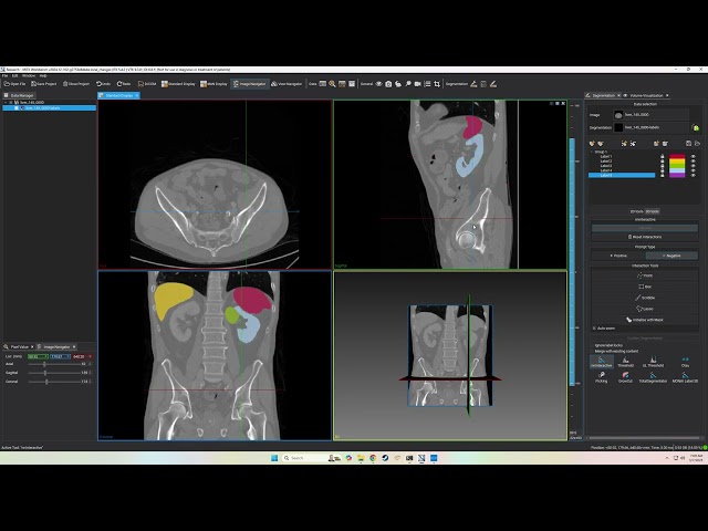[MITK] CT organ segmentation with nnInteractive