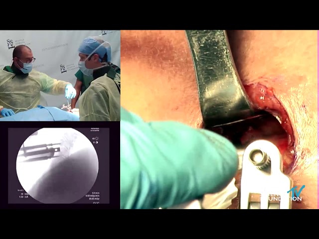 Cervical Total Disc Replacement    Amir Abdul Jabbar, M D