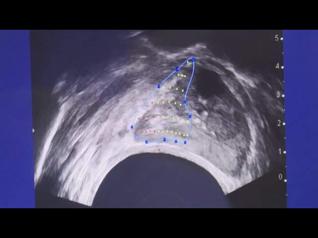 60% of prostate cancer patients are opting out of treatment & living just as long, study finds