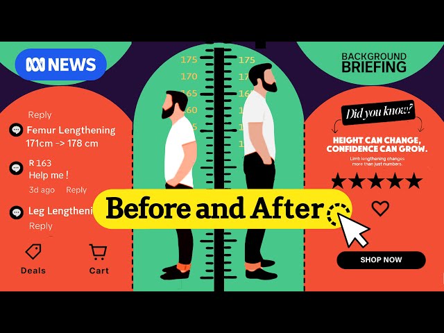 For a couple extra inches | Before and After | Episode 2 | Limb lengthening surgery investigation