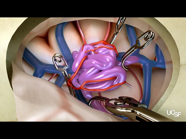 Arteriovenous Malformations (AVMs) | Surgical Treatment Options at UCSF