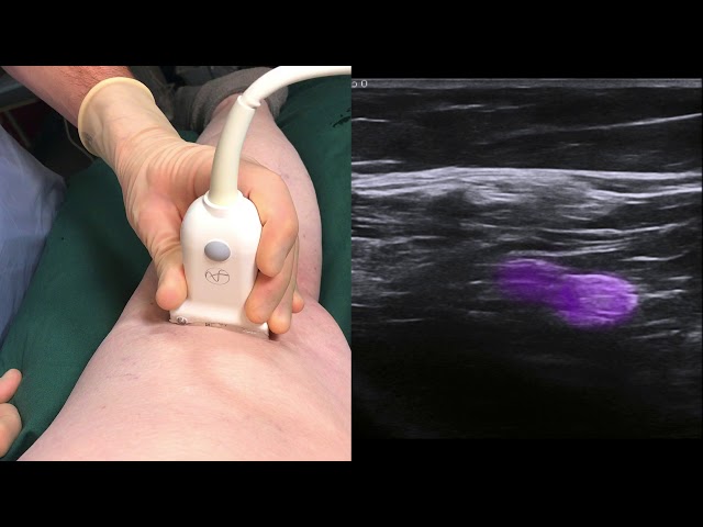 Ultrasound guided popliteal sciatic nerve block