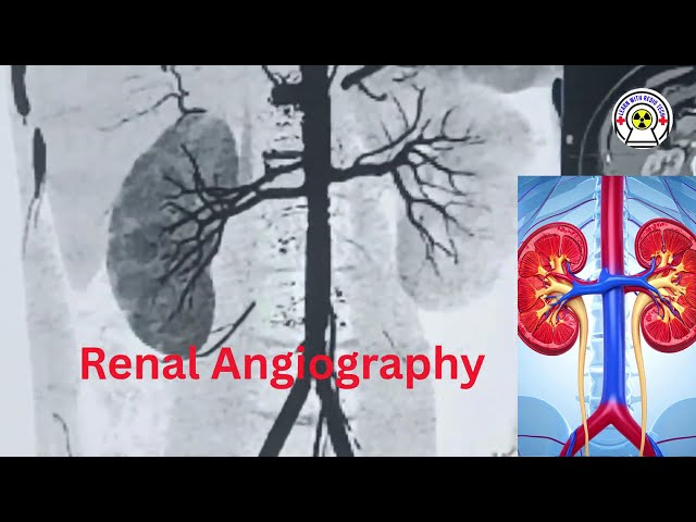 RTENAL ANGIOGRAPHY #RenalAngiography #Radiology #MedicalLearning #KidneyScan #Radiology of student