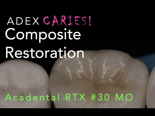 Composite Restoration for ADEX/CDCA Examination #30 MO