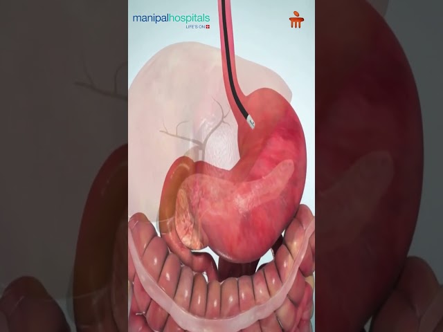 ERCP Procedure Explained | Dr. Pratap Bahera | MBO