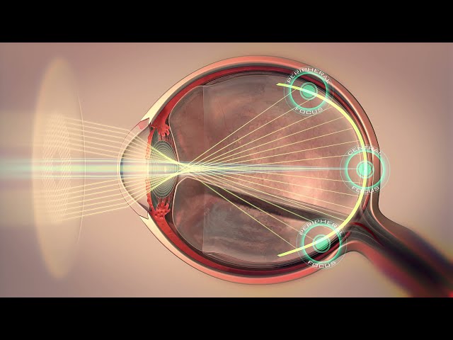 Myopia Control: MiyoSmart lens technology explained