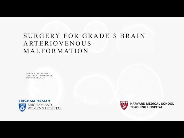 Surgical Video for Resection of a Grade 3 Brain AVM