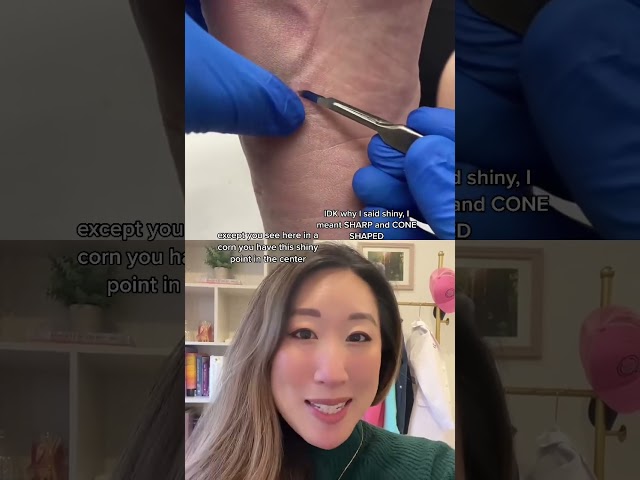 #corn #callus removal videos are SO SATISFYING! This provides instant relief #dermbypark #shorts