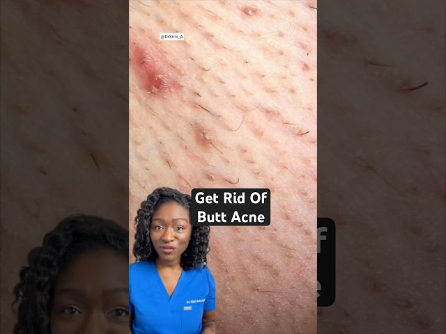 Butt Acne 🍑 Why You Get It & How to Get Rid of It!