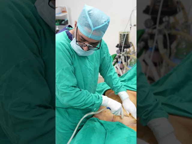 Liposuction Surgery #abdomen #tummy #shorts #ytshort