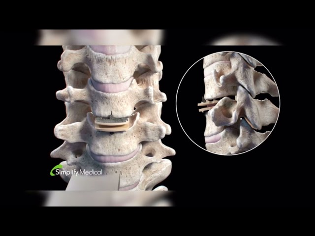 𝘾𝙚𝙧𝙫𝙞𝙘𝙖𝙡 𝘿𝙞𝙨𝙘 𝙍𝙚𝙥𝙡𝙖𝙘𝙚𝙢𝙚𝙣𝙩 (explained by an expert)