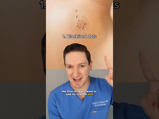 Dermatologist explains how to tell if you have a wart! #wart #verruca #whatsonmyskin #plantarwart