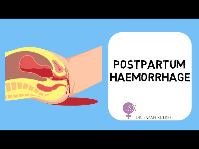 Postpartum Haemorrhage