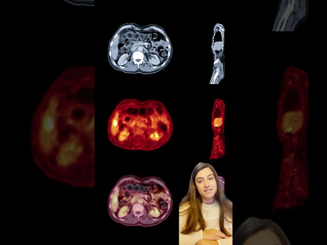 The Basics of PET Scans