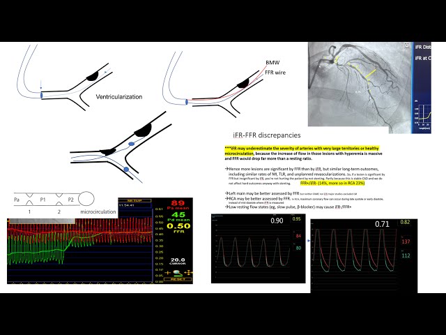 FFR-iFR: concepts, technical pitfalls, applications in various lesion types-Elias hanna