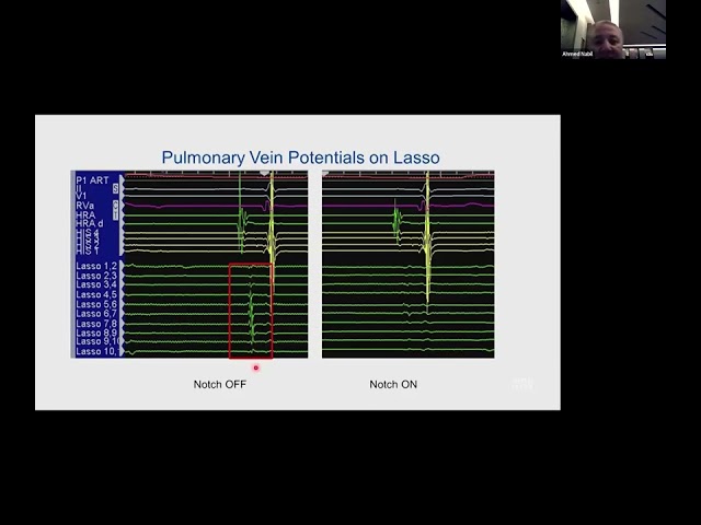 Intracardiac signal processing Biophysics of Cardiac Ablation by Prof  Ahmed Nabil, MD