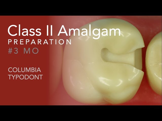 Class II Amalgam Preparation #3 MO