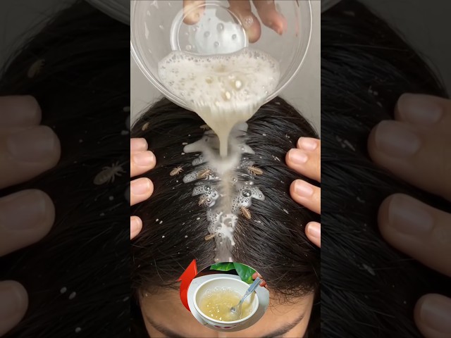 Best Treatment For Lice Problem #shorts #haircare #hairgrowth #beauty #beautytips