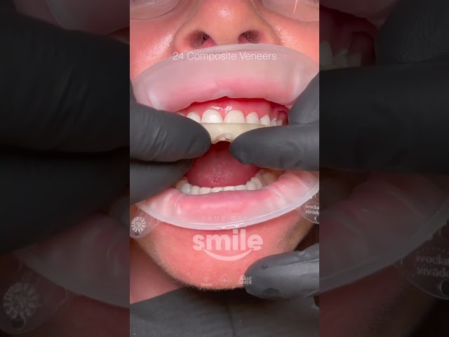 24 Composite Veneers, 2 Hours, 1 Day, 0 Tooth Prep💥