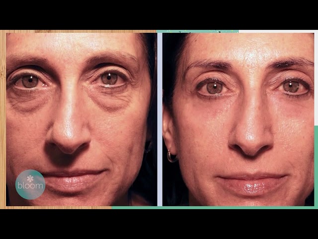The Treatment That Works: Dr. Scheiner on Malar Bags and Festoons
