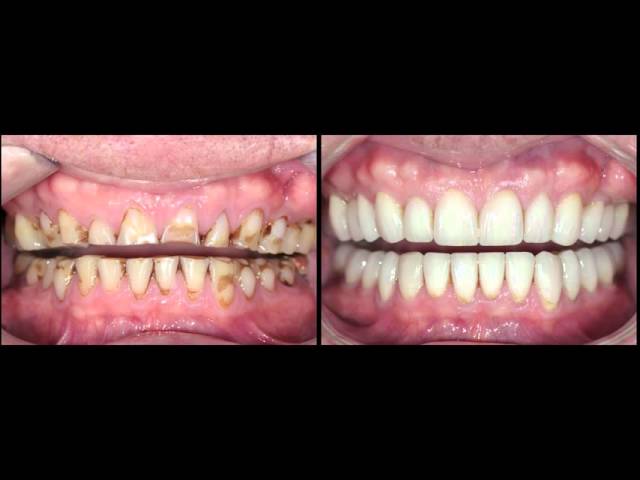 Full mouth rehabilitation for advanced tooth wear case study by Dr. Stephen Phelan
