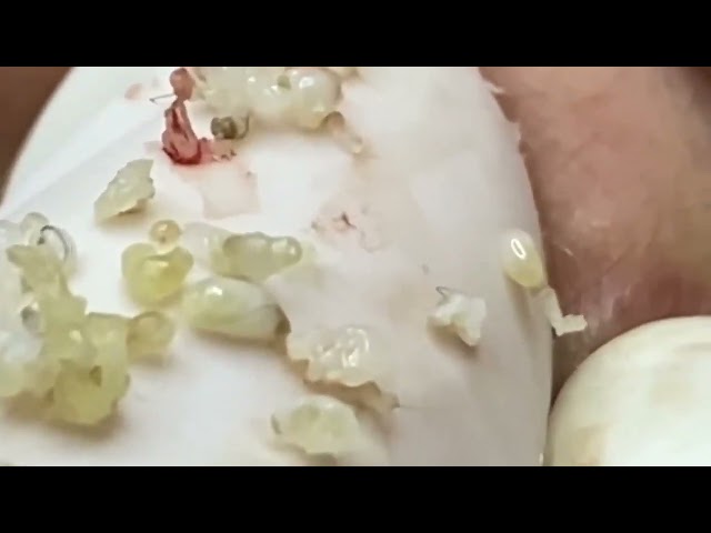 Extreme Blackhead Removal | Deep Pore Cleaning & Satisfying Extraction #4000