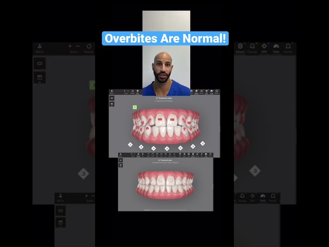 Overbites Are Normal!